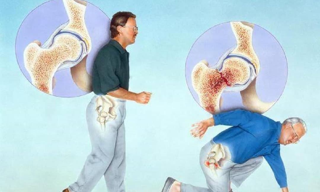 'Máy gia tốc' loãng xương đã được tìm thấy? Nếu bạn muốn xương khỏe mạnh, hãy tránh xa '2 xanh và 1 trắng'