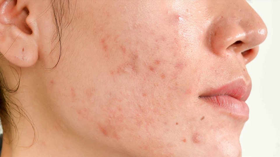 2 mẹo trị sẹo thâm trên mặt nhanh chóng, hiệu quả dành cho phái đẹp